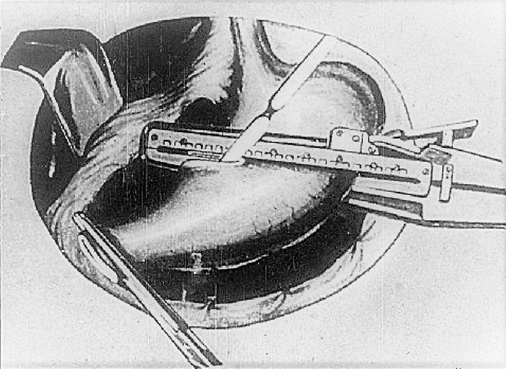 UKZ-8-Stapler im Einsatz bei Magenoperation