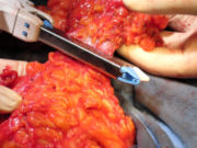 Sezione di un segmento intestinale con GIA